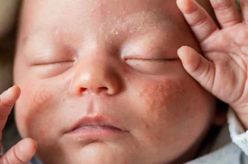 Does Microbiome Testing Help with Infant Eczema? What Parents Need to Know